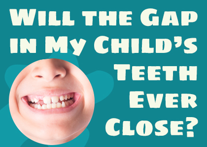 Odenton dentists Drs. Kenny and Sarrah Zamora of Bayside Kids Dental talks about potential causes and treatments for gapped teeth in children.