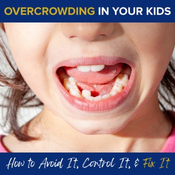 Odenton dentists, Drs. Kenny and Sarrah Zamora at Bayside Kids Dental, discuss overcrowding- how to spot it, control it, and fix it. Read on to learn what to look out for and the treatment options available to help your child achieve a straighter, healthier smile.