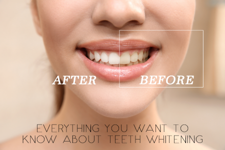 Bayside Kids Dental go over the details of teeth whitening.
