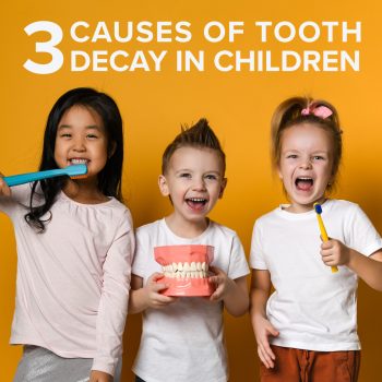 Odenton dentists, Drs. Kenny and Sarrah Zamora at Bayside Kids Dental, share the three major causes of tooth decay in children.